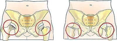 Combnyaktörés gyógytornája